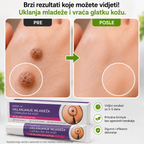 EELHOE Crema para eliminar lunares