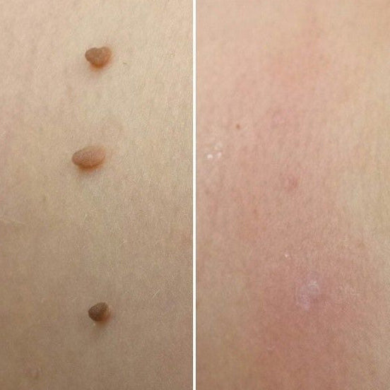 Apheliox Stielwarzen-Set