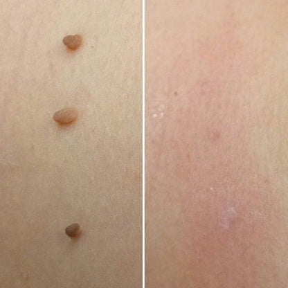 Apheliox Stielwarzen-Set